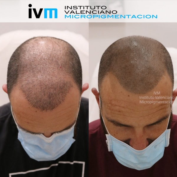 TRICO-IVM