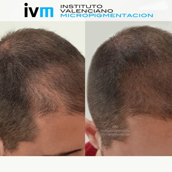 TRICO-IVM