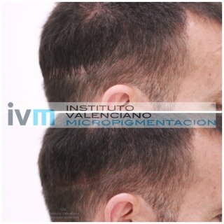 TRICO-IVM-2