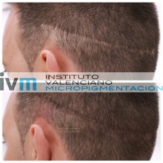 TRICO-IVM-3