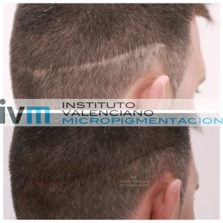 TRICO-IVM-4