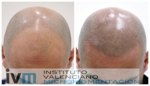 TRICO-IVM-5