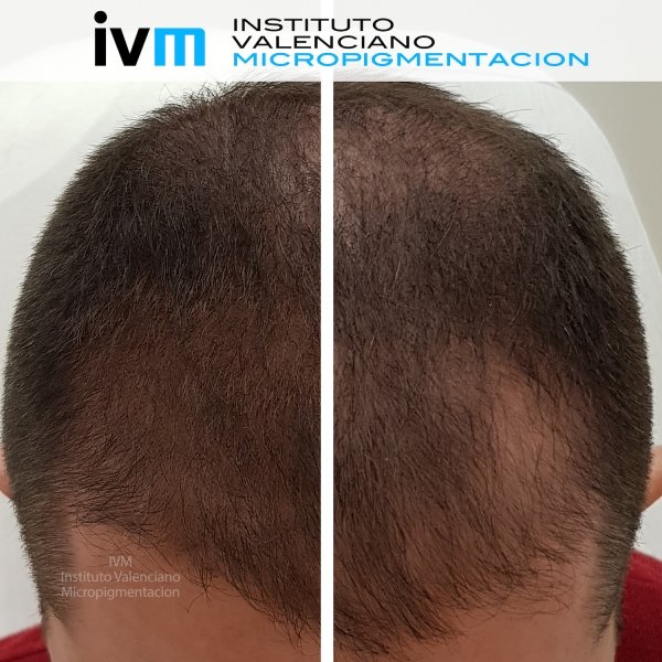 TRICO-IVM