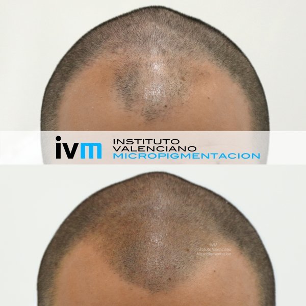 TRICO-IVM