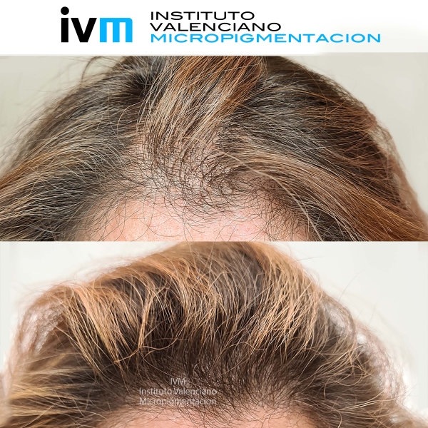 TRICO-IVM