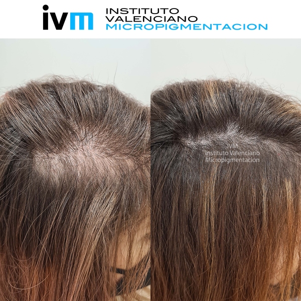 TRICO-IVM