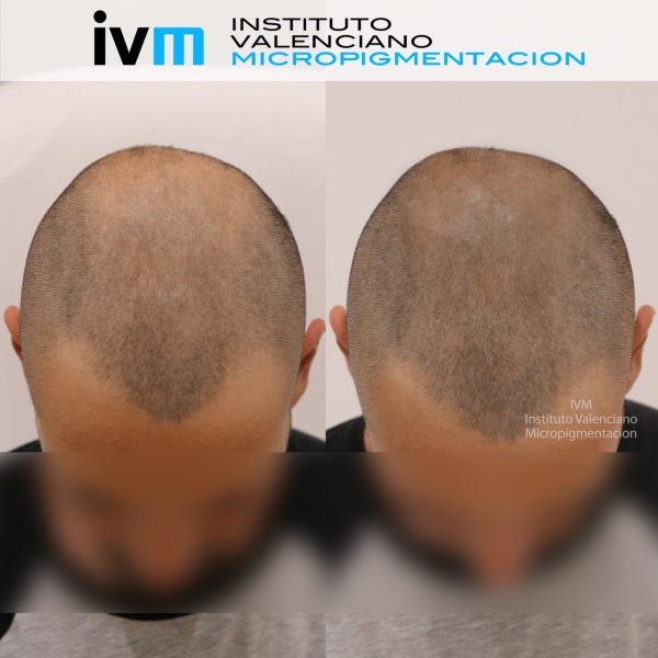 TRICO-IVM