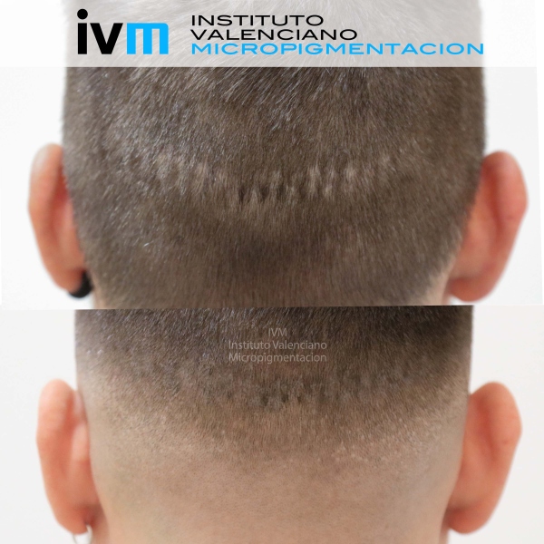 TRICO-IVM