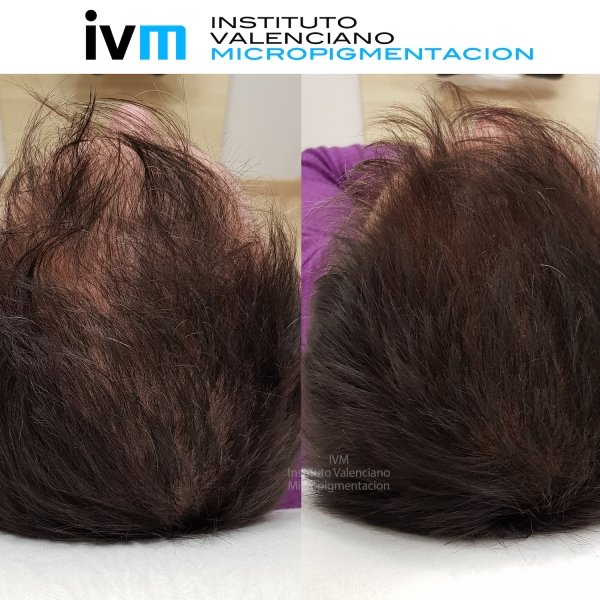 TRICO-IVM