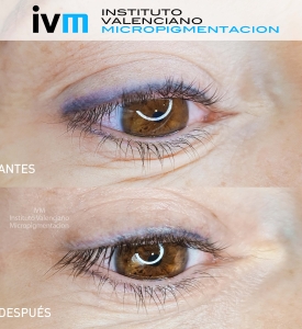 ELIMINACION_IVM