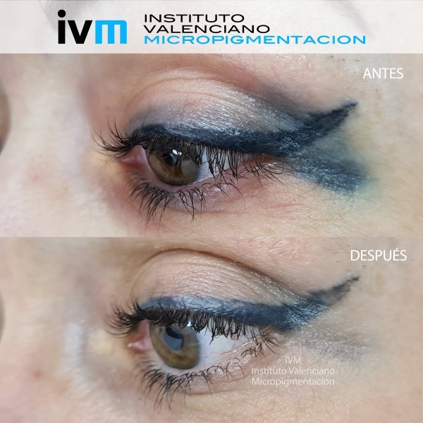 ELIMINACION_IVM