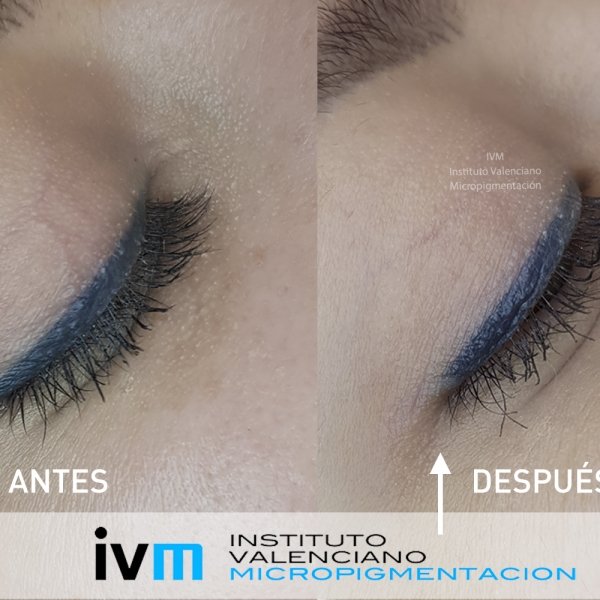 ELIMINACION_IVM