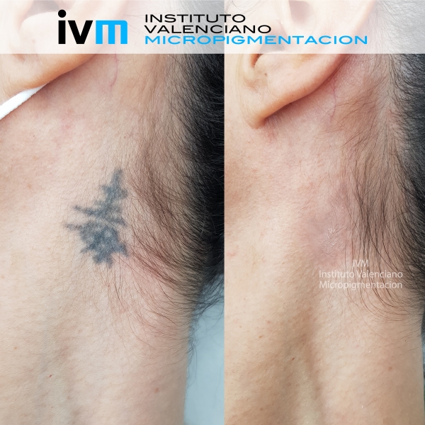 ELIMINACION_IVM