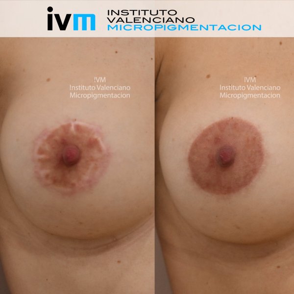 Reconstruccion-Areola-IVM